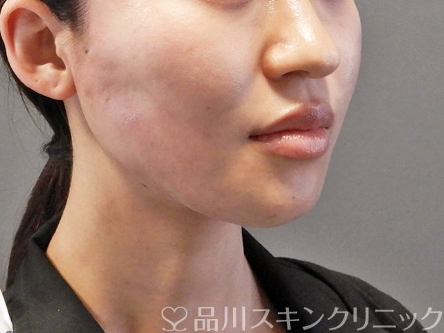 症例NO.64384のAFTER写真