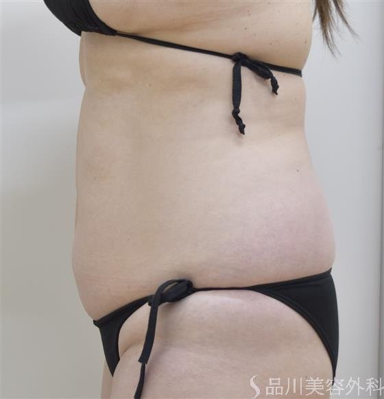 症例NO.45927のAFTER写真