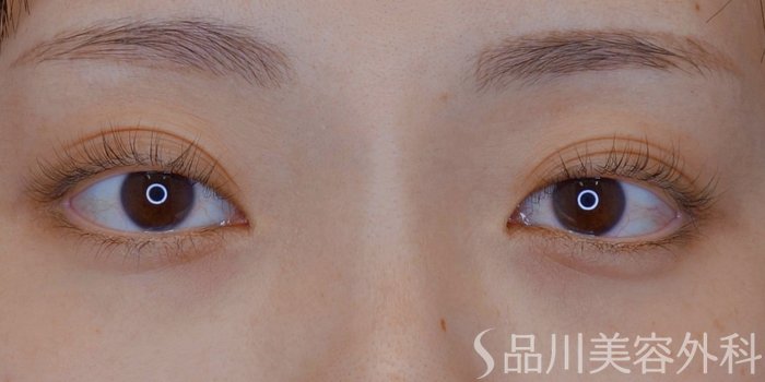 症例NO.73880のBEFORE写真