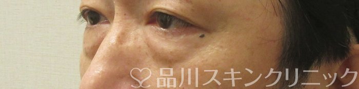 症例NO.74836のBEFORE写真