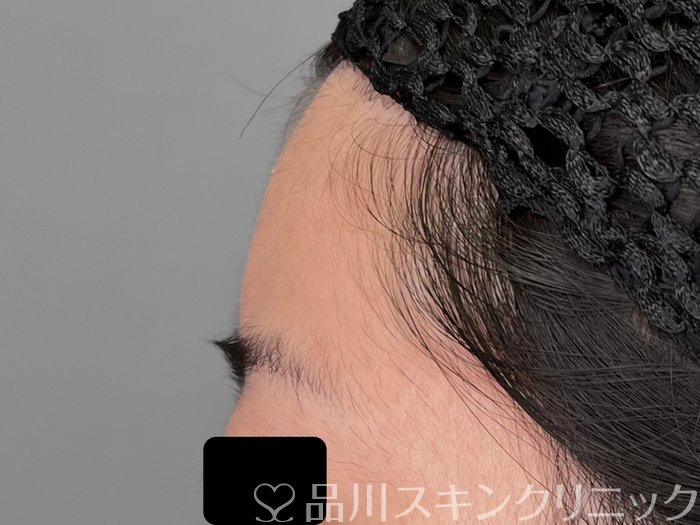 症例NO.70083のBEFORE写真