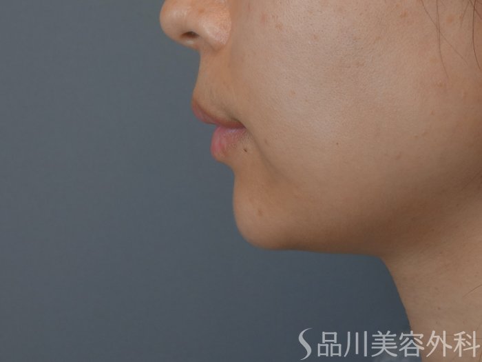症例NO.69659のBEFORE写真