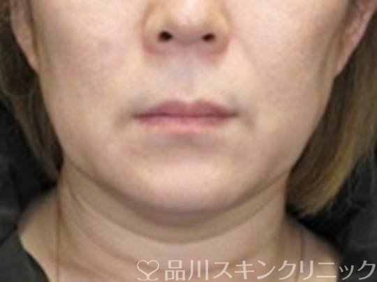 症例NO.73947のBEFORE写真
