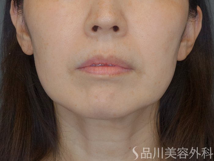 症例NO.71924のBEFORE写真