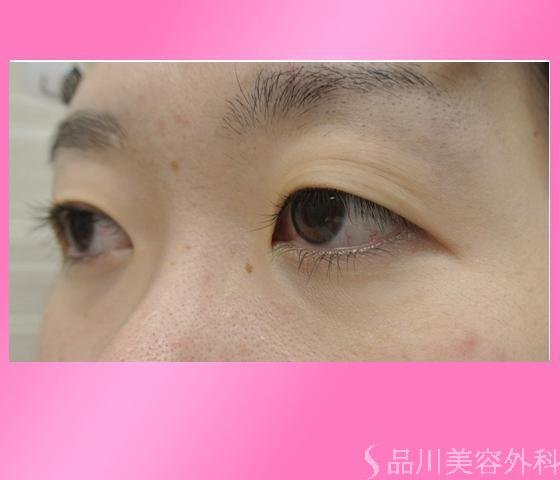 症例NO.14605のBEFORE写真