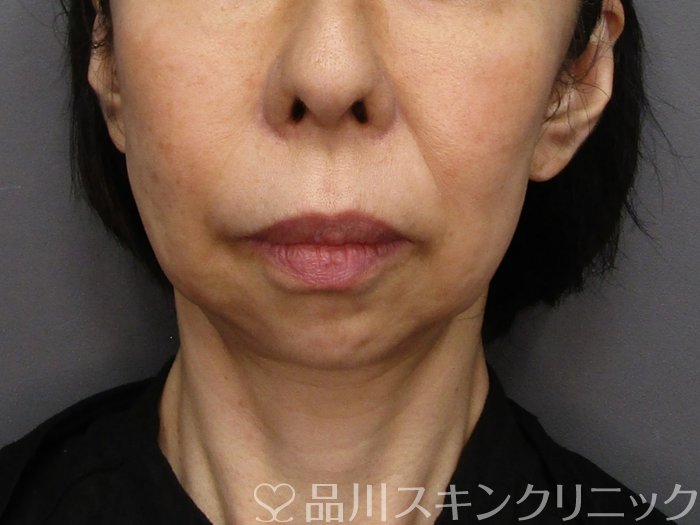 症例NO.75101のBEFORE写真
