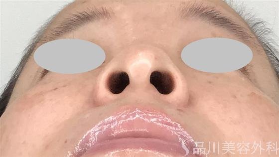 症例NO.59579のBEFORE写真