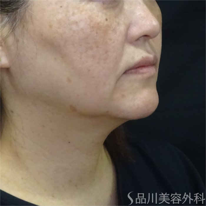 症例NO.71144のBEFORE写真