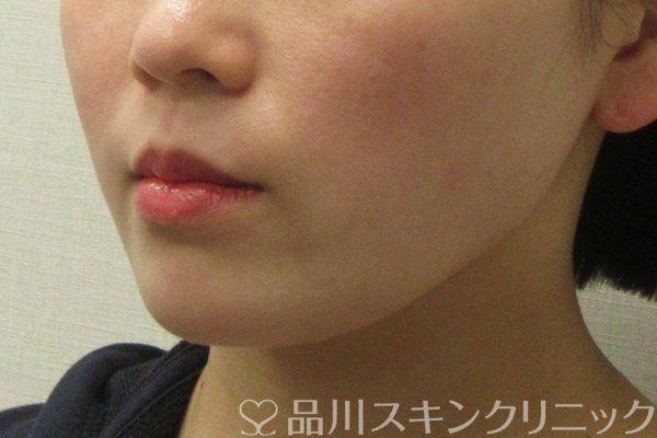 症例NO.75078のBEFORE写真