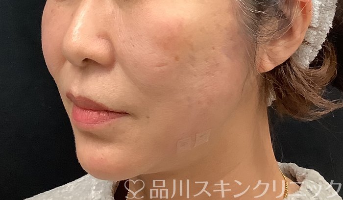 症例NO.67964のAFTER写真