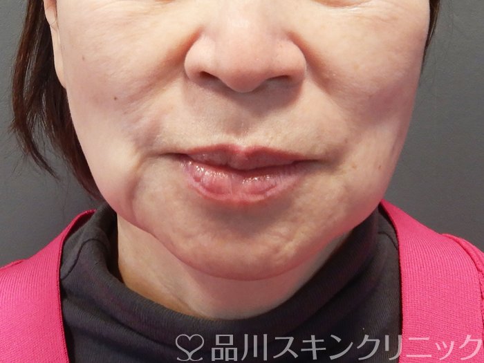 症例NO.73439のBEFORE写真