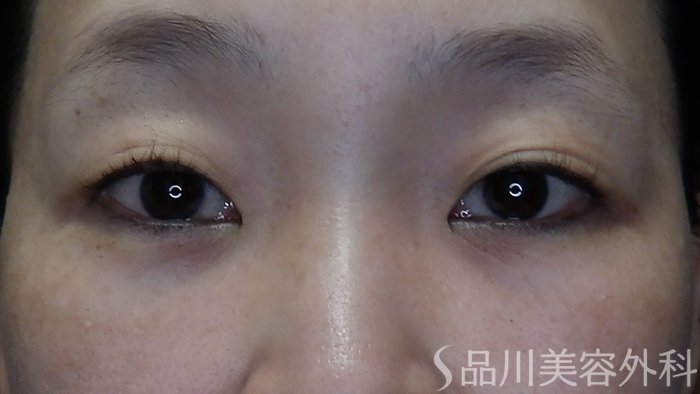 症例NO.73668のBEFORE写真