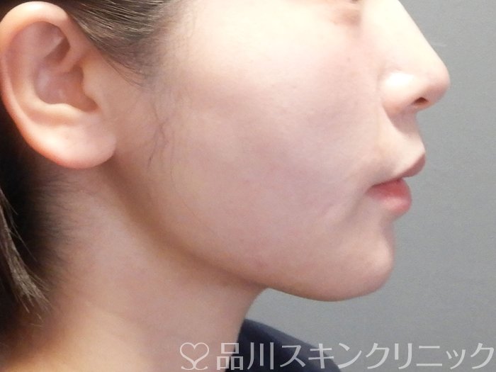 症例NO.73239のAFTER写真