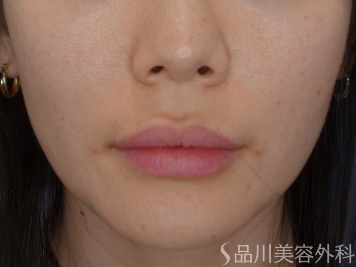 症例NO.73446のAFTER写真