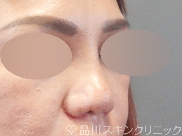 症例NO.67917のAFTER写真