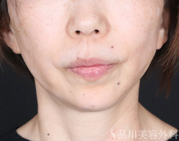 症例NO.73410のAFTER写真