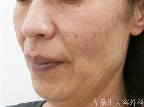 症例NO.25629のBEFORE写真