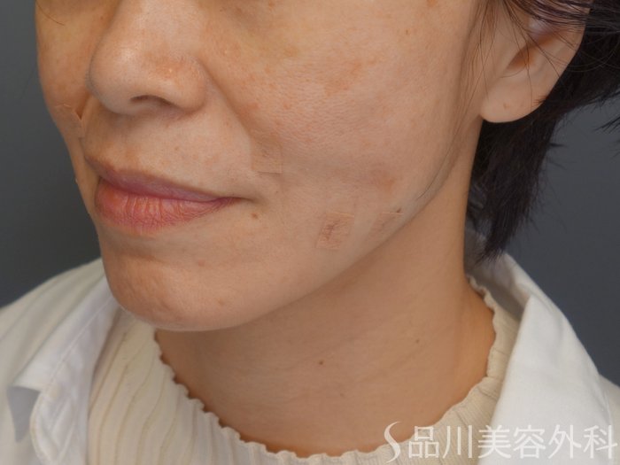 症例NO.65495のAFTER写真
