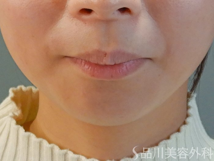 症例NO.69730のBEFORE写真