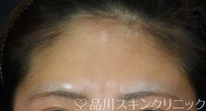 症例NO.72795のAFTER写真