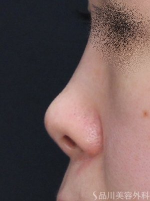 症例NO.74585のBEFORE写真