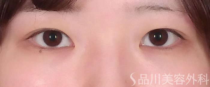 症例NO.70104のBEFORE写真