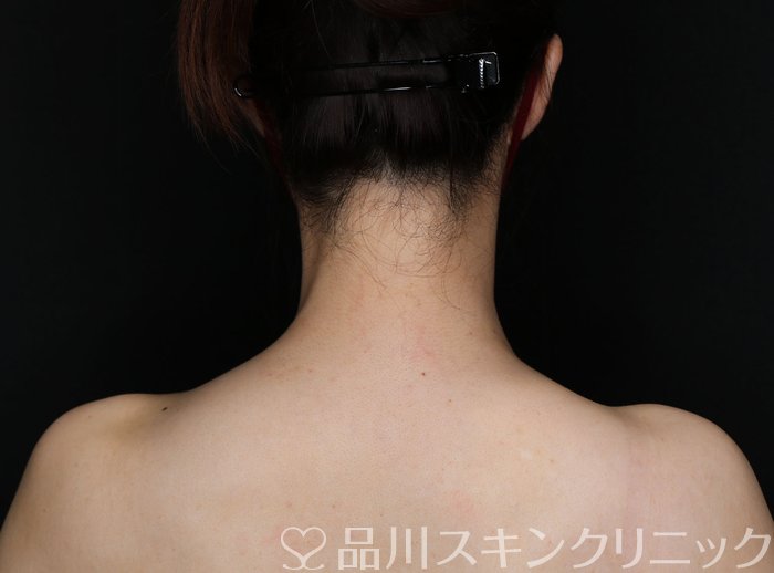 症例NO.67821のAFTER写真
