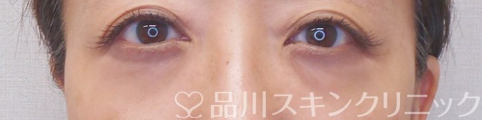 症例NO.71049のAFTER写真