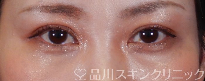 症例NO.64889のAFTER写真