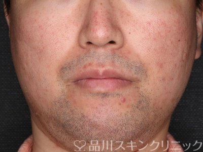 症例NO.75085のBEFORE写真