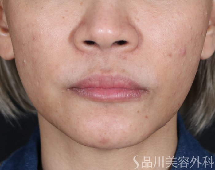 症例NO.71140のBEFORE写真