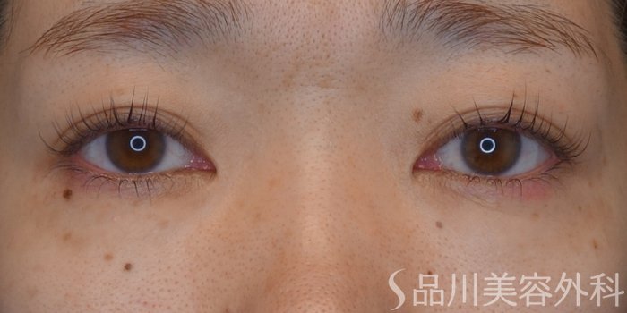 症例NO.73329のBEFORE写真