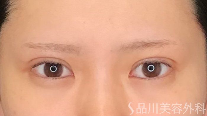 症例NO.62992のAFTER写真