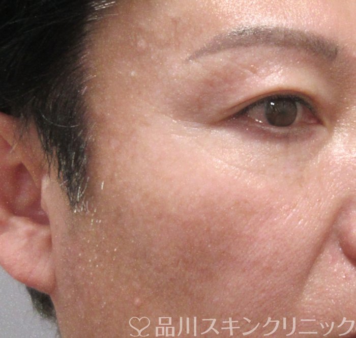 症例NO.74253のAFTER写真
