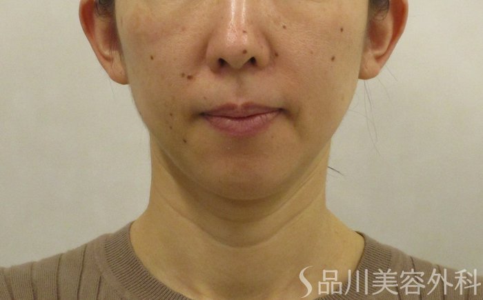 症例NO.62346のBEFORE写真