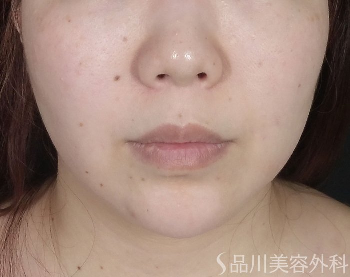 症例NO.65322のBEFORE写真