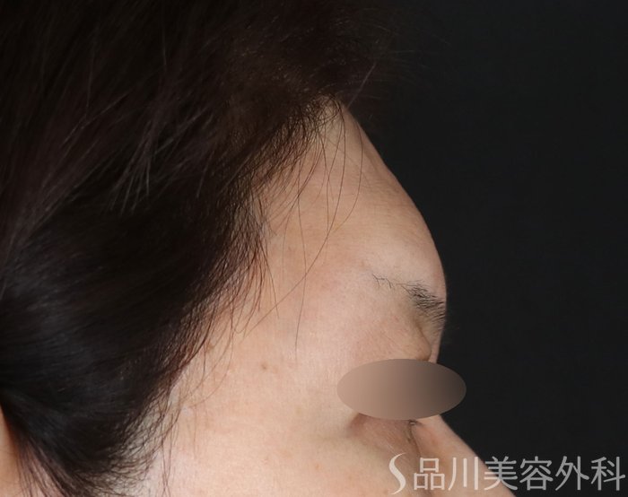 症例NO.72930のAFTER写真