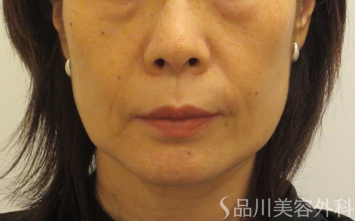 症例NO.71739のBEFORE写真