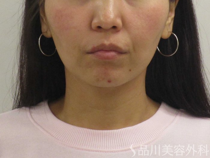 症例NO.75381のBEFORE写真