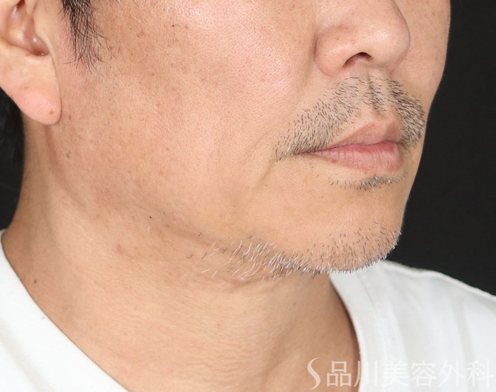 症例NO.74275のBEFORE写真