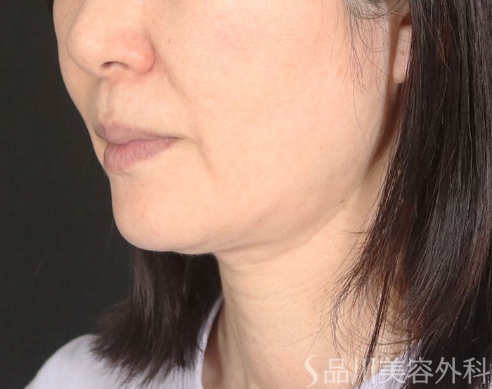 症例NO.73767のBEFORE写真