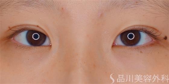 症例NO.59851のAFTER写真