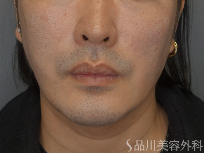 症例NO.73963のAFTER写真