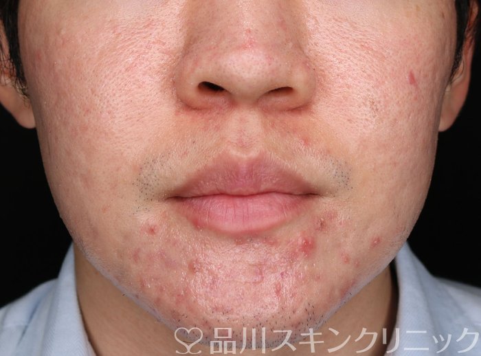 症例NO.74125のBEFORE写真