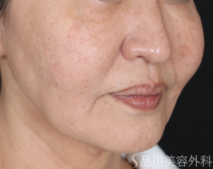 症例NO.70917のBEFORE写真