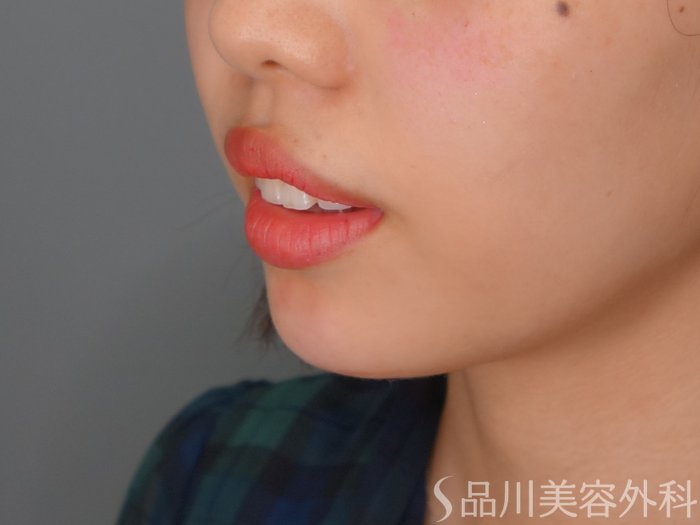 症例NO.69878のAFTER写真