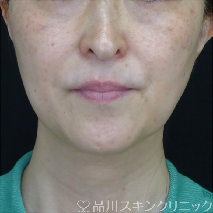 症例NO.70167のBEFORE写真