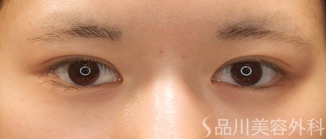 症例NO.73254のBEFORE写真