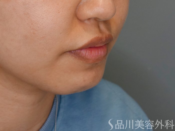 症例NO.69459のBEFORE写真
