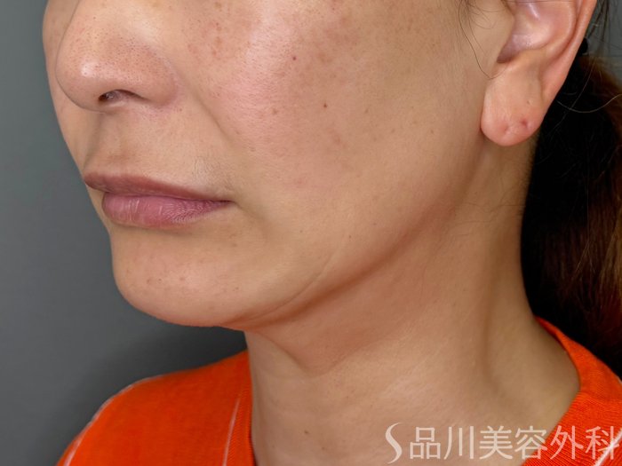 症例NO.71441のBEFORE写真